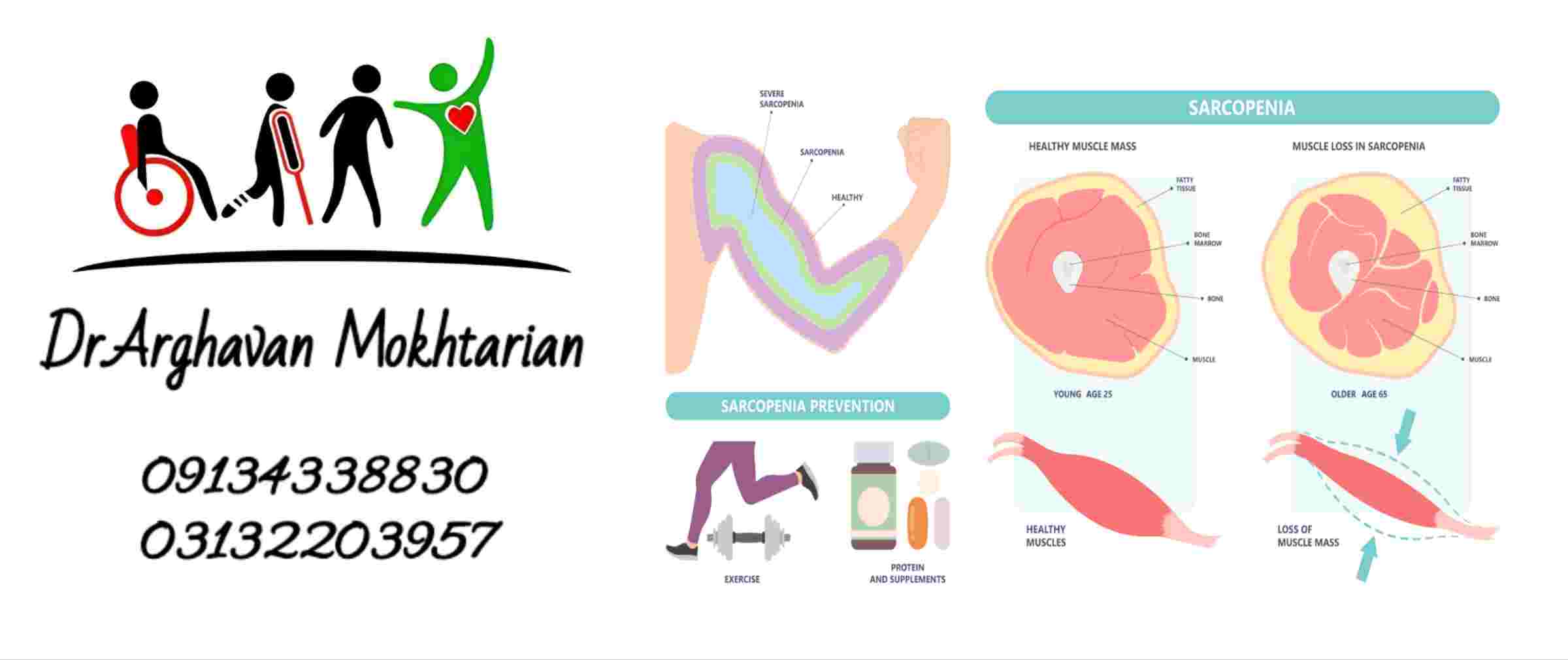 سارکوپنی یا تحلیل عضله