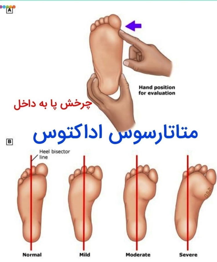 متاتارسوس اداکتوس