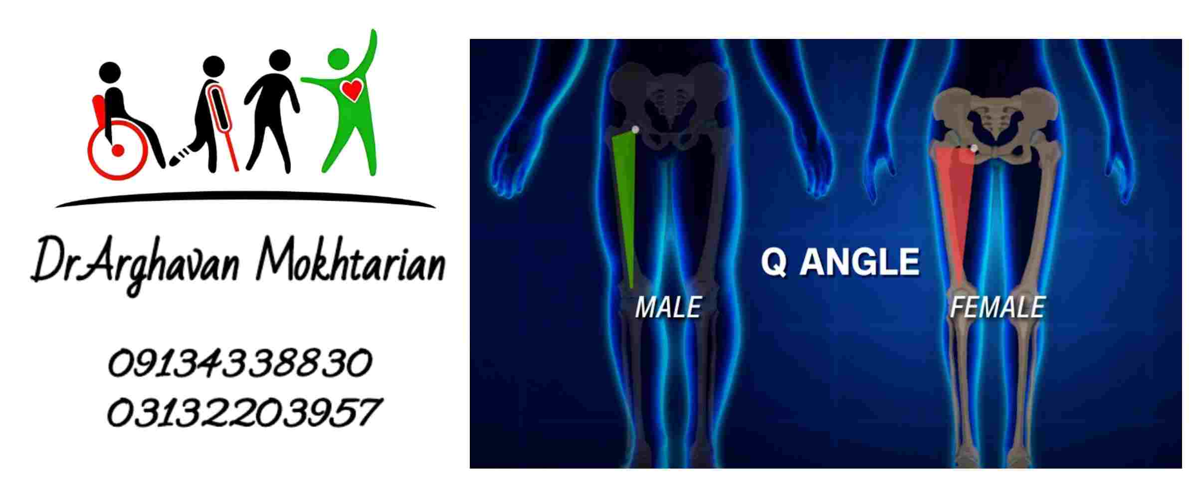 تفاوت زاویه Q در مردان و زنان و استعداد بالاتر خانم ها به زانو درد