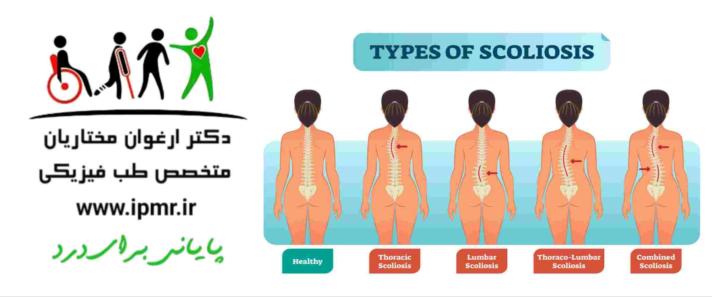 نکات کاربردی برای استفاده از بریس اسکولیوز