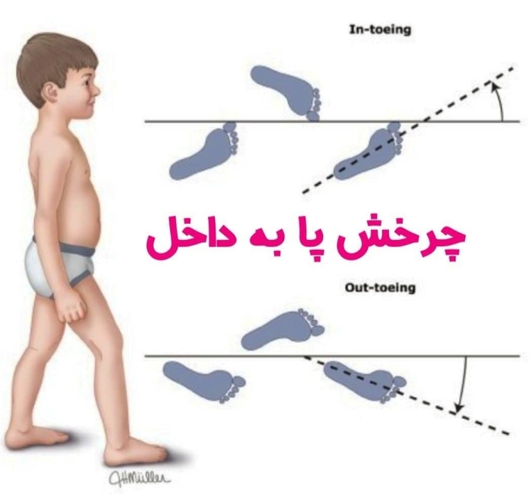 علل چرخش پا به داخل