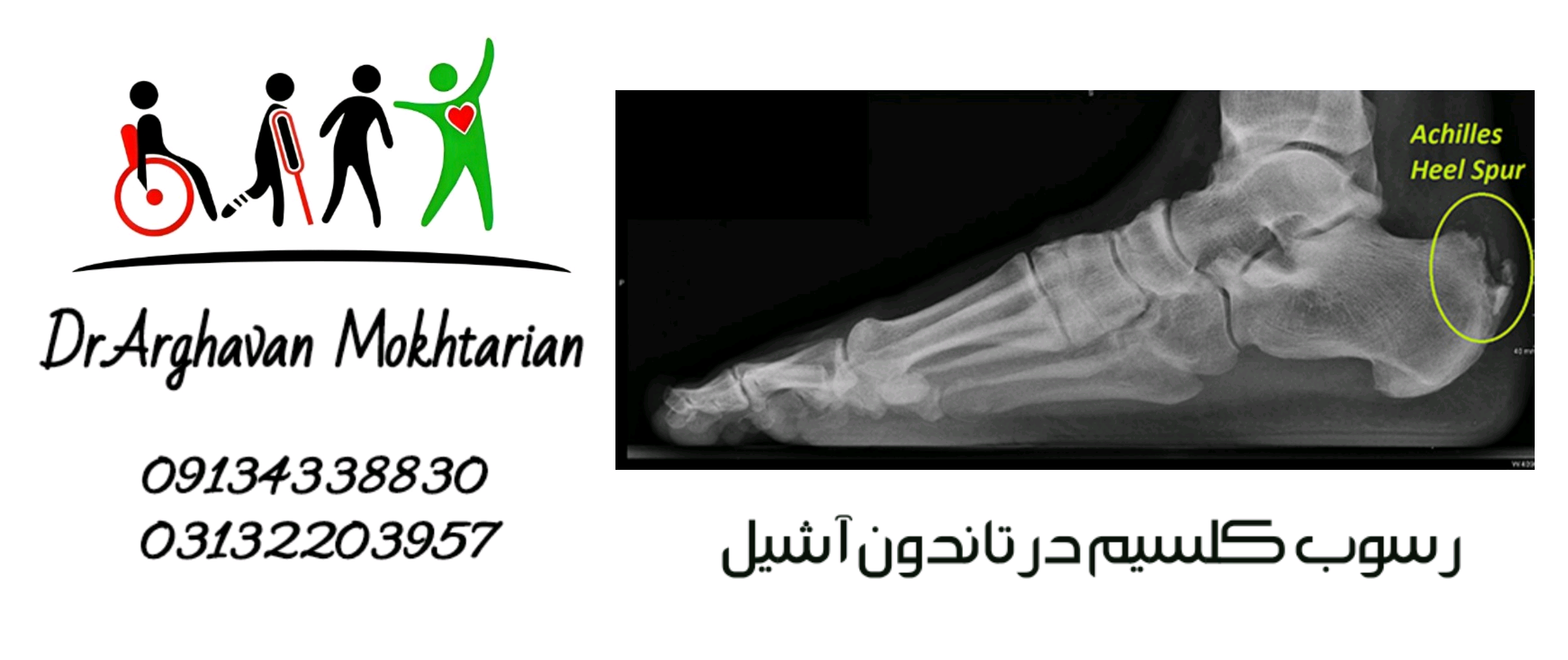 رسوب کلسیم در تاندون آشیل