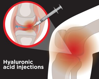 تزریق ژل، تزریق هیالورونیک اسید، تزریق اسید هیالورونیک، تزریق ژل زانو، تزریق داخل مفصلی
