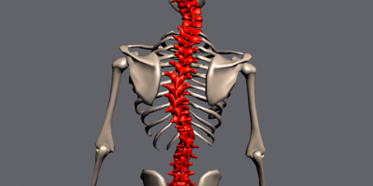 انواع اسکولیوز یا انحراف جانبی ستون فقرات