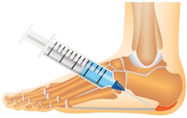 فواید و عوارض تزریق کورتون در درمان خار پاشنه