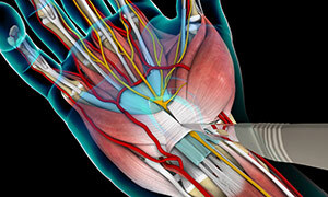 سندرم تونل کارپال یا گرفتگی عصب دست