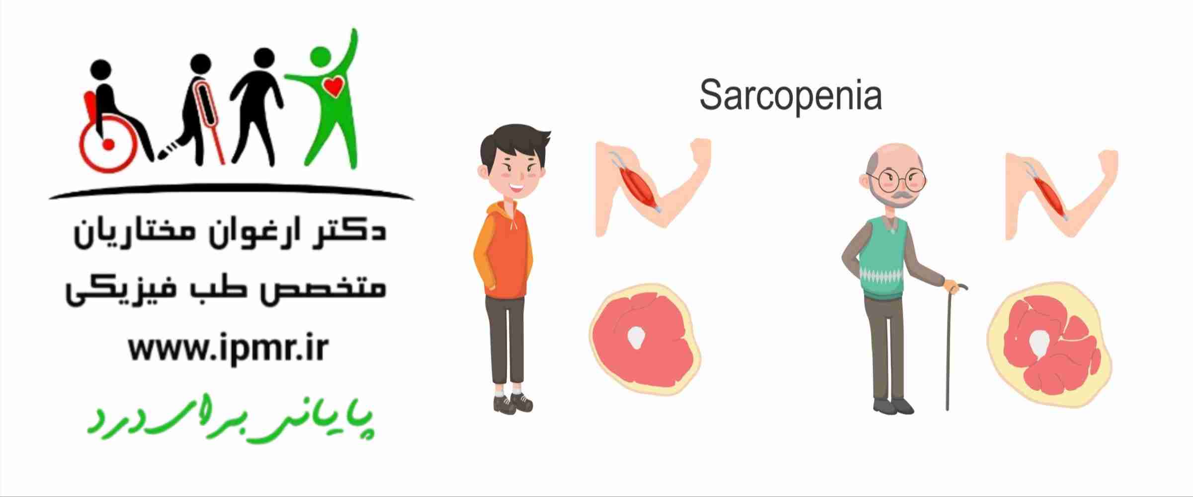 سارکوپنی یا تحلیل عضله